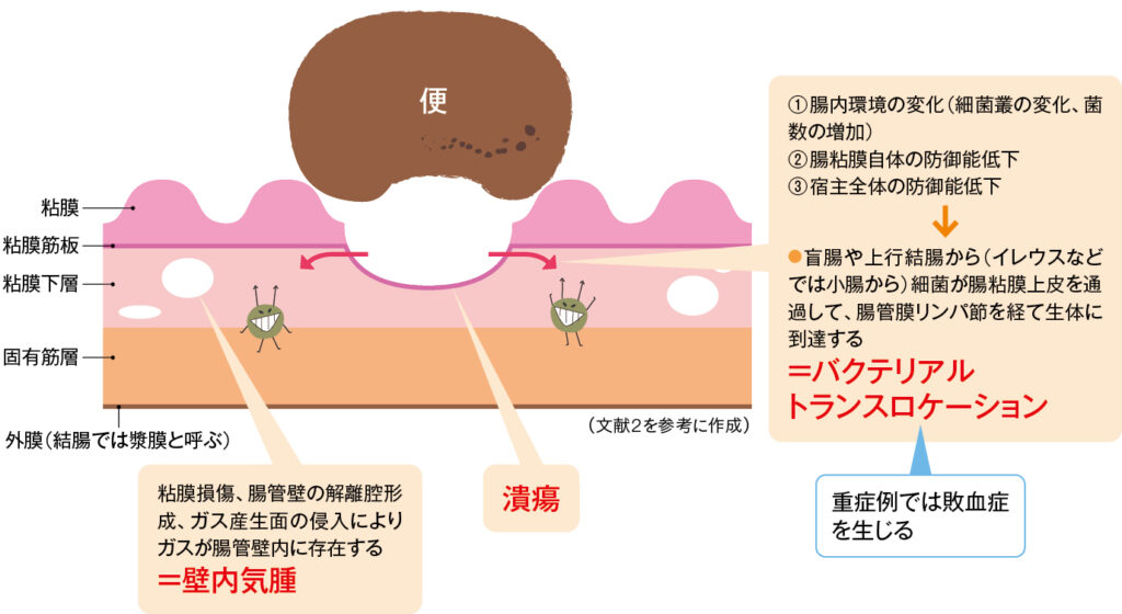 宿便性潰瘍により起こること
