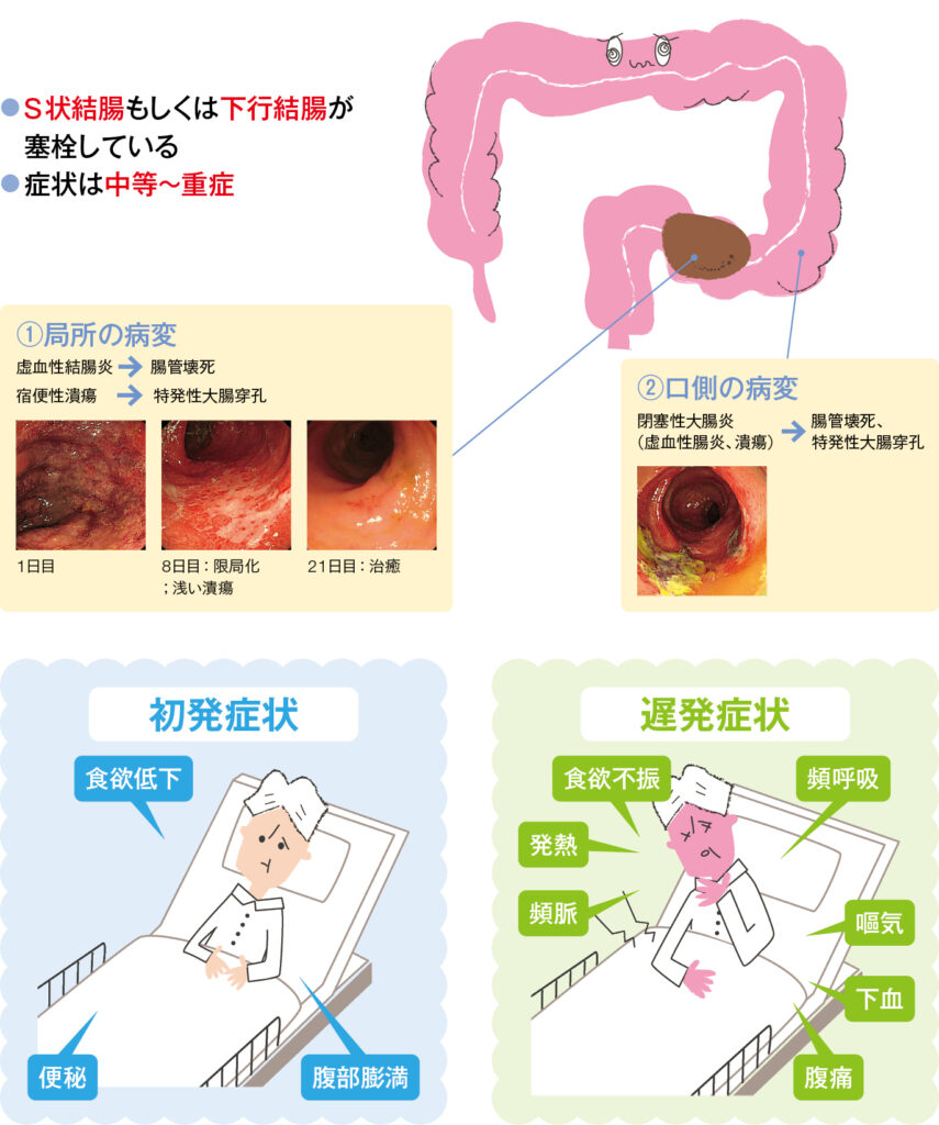 糞便塞栓(結腸)