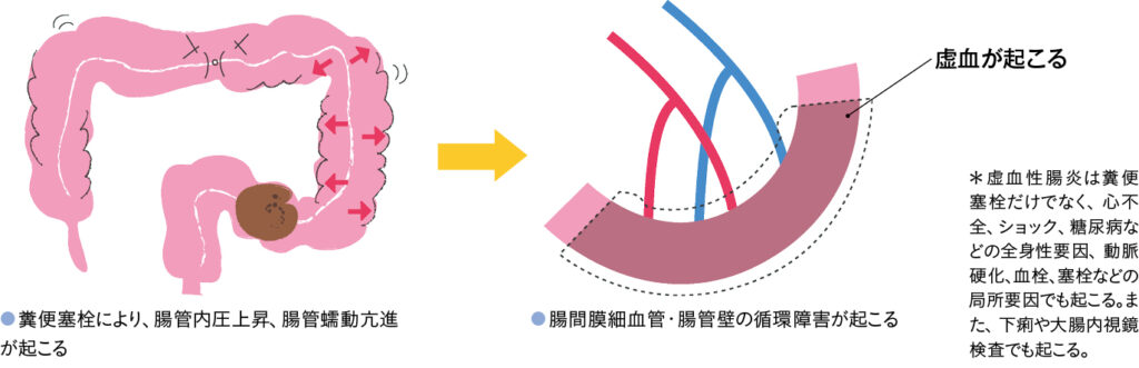 虚血症腸炎のメカニズム