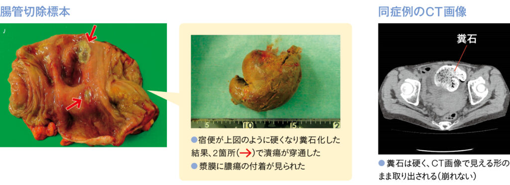 糞石による潰瘍の穿通