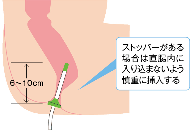 浣腸カテーテル挿入のめやす