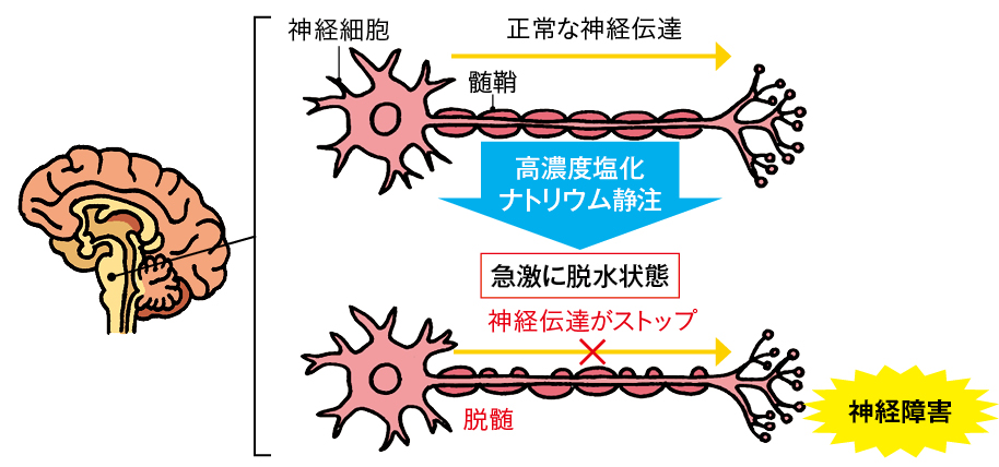 浸透圧性脱髄症候群