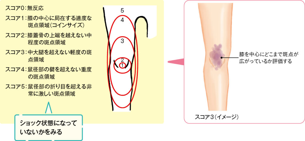 「Mottling score」（斑状皮膚スコア）