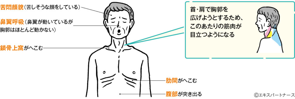 努力呼吸の徴候