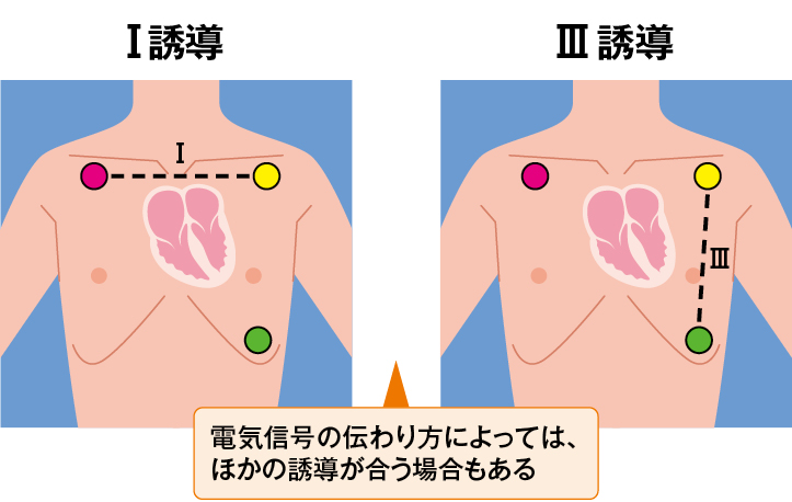 モニタ心電図のⅠ誘導・Ⅲ誘導