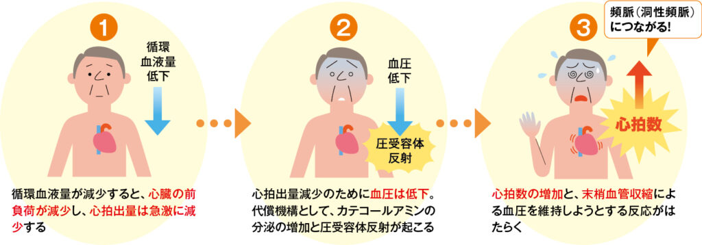 循環血液減少性ショック（hypovolemic shock）