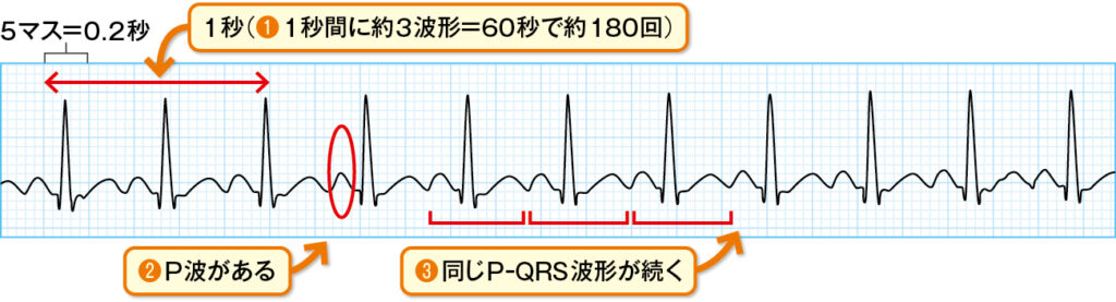 洞性頻脈の心電図波形