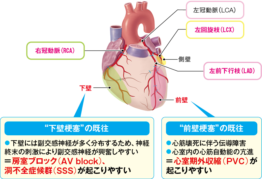 心筋梗塞部位に基づく“起こりやすい不整脈”