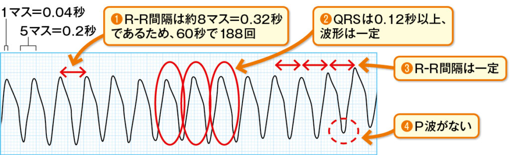 心室頻拍（VT）の心電図波形