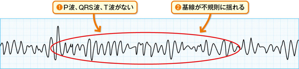 心室細動（VF）の心電図波形