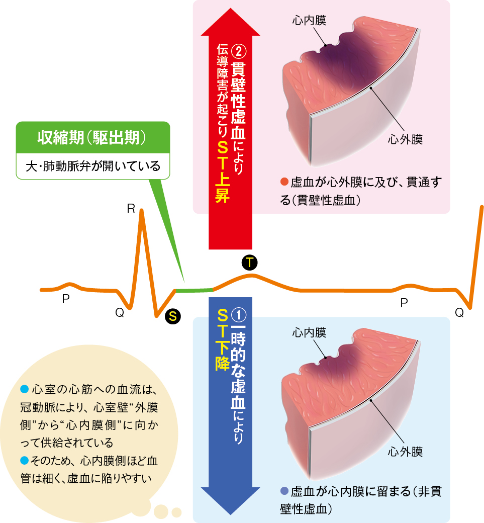 狭心症によって起こるST変化