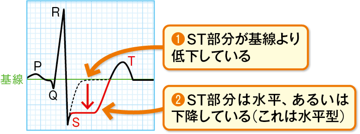 ST下降の心電図波形