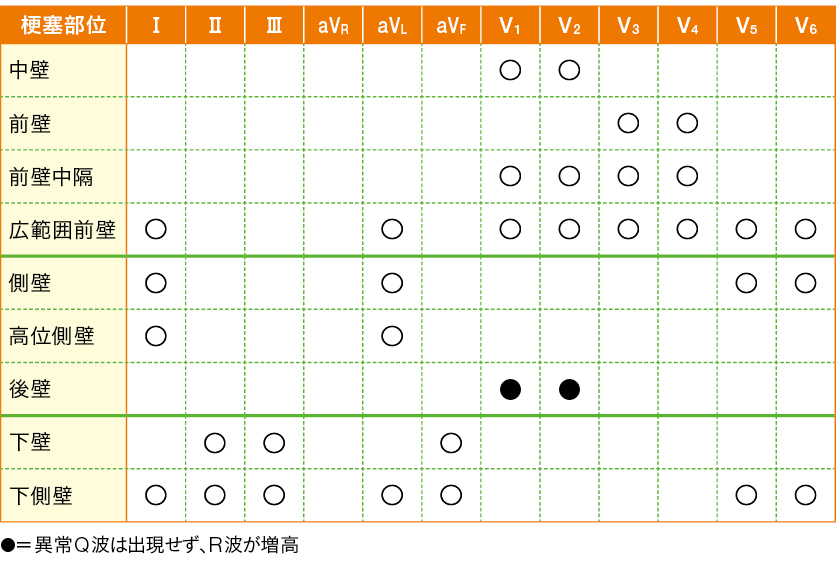 12誘導によるST波の観察と推測される梗塞部位