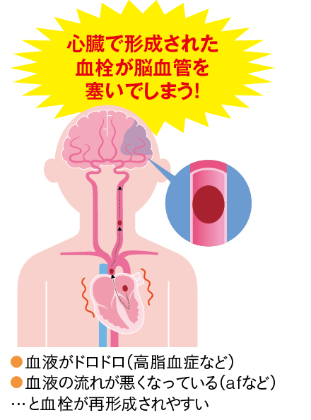 心原性脳梗塞とは