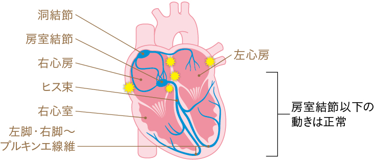 心房細動の心臓イラスト
