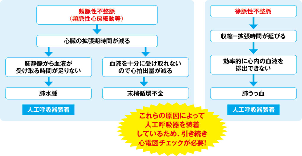 人工呼吸器装着患者の背景で起こっていること（不整脈が原因の場合）