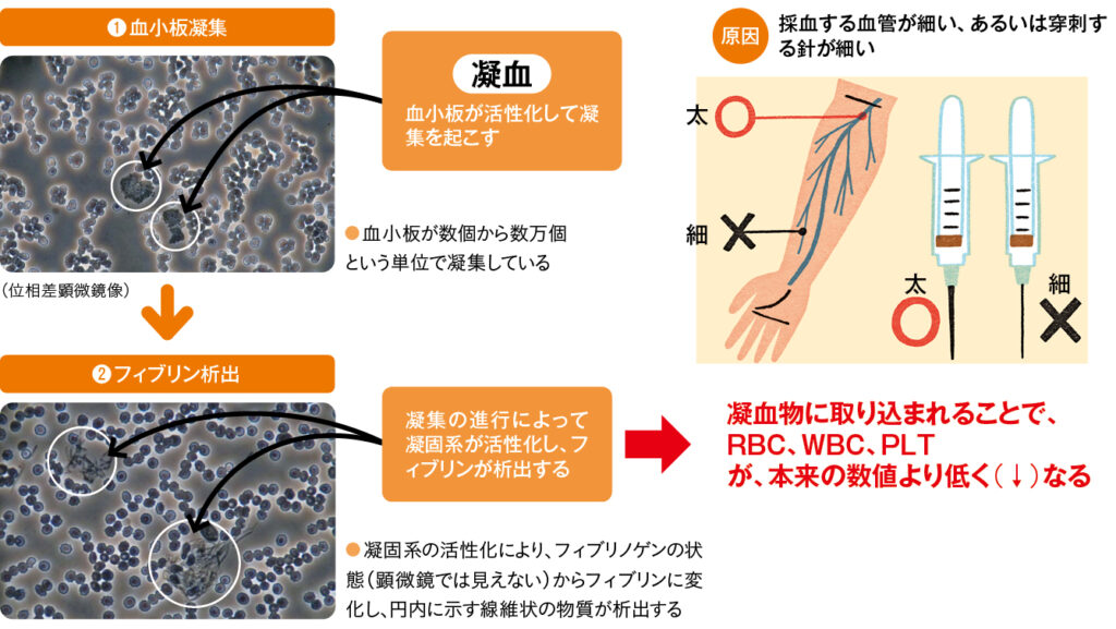 溶血・凝血が血液一般検査に与える影響