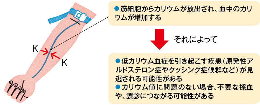 カリウムの偽高値による影響