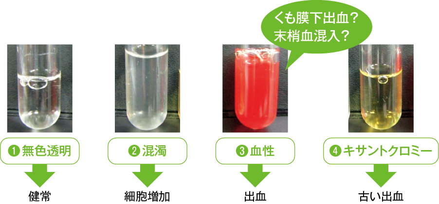 髄液の色調の種類