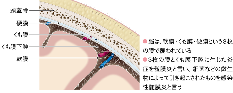 髄膜炎の生じる部位