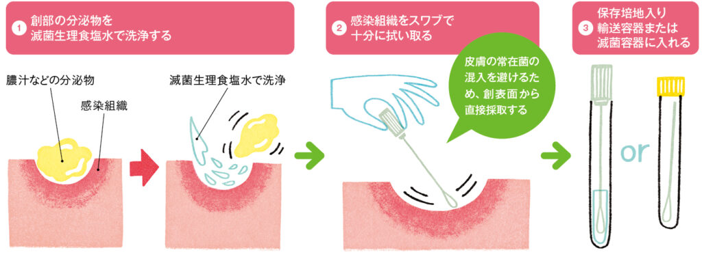 スワブによる創部の検体採取法
