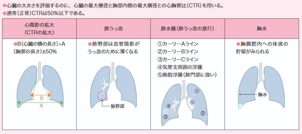 心不全で特徴的なX線所見