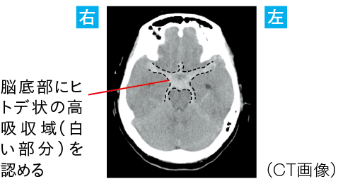 「くも膜下出血」による“髄膜刺激症状”としての頭痛のCT画像