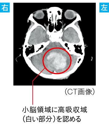 「小脳出血」を原因とした“小脳損傷”による嘔吐・めまいのCT画像