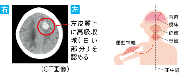「左皮質下出血」による“大脳皮質障害”を原因としたけいれんのCT画像とイラスト