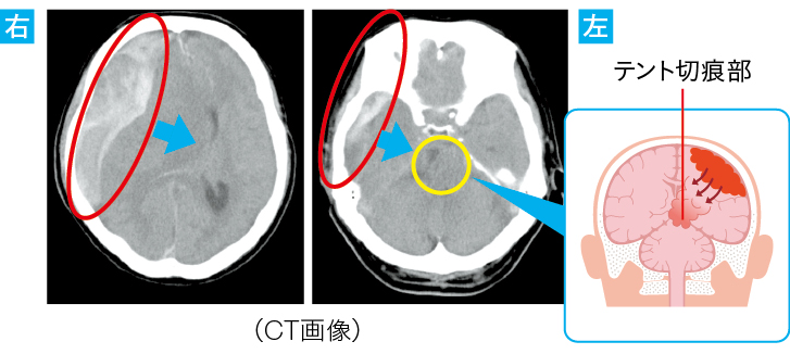 「外傷性硬膜下血腫」を原因とした“テント切痕ヘルニアのCT画像