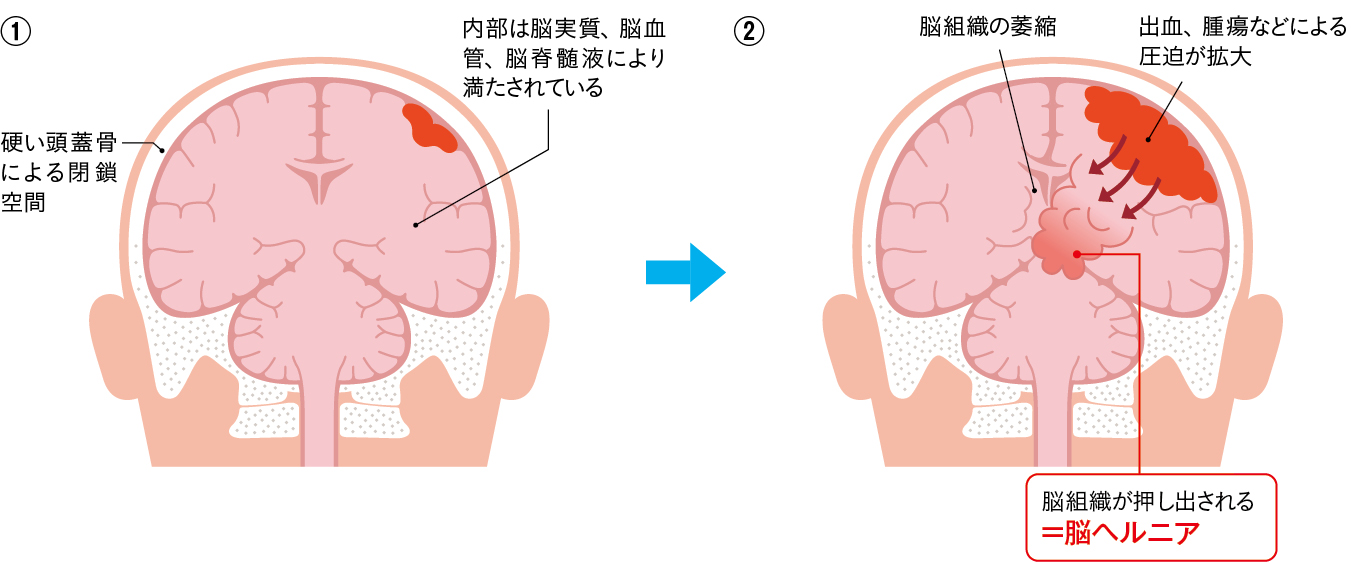 脳ヘルニアのイメージイラスト