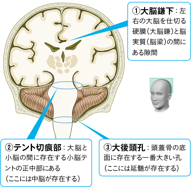 脳ヘルニアが起こりやすい部位のイラスト