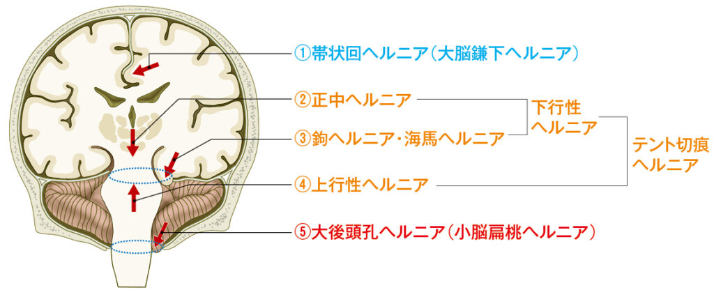 脳ヘルニアの部位を説明するイラスト