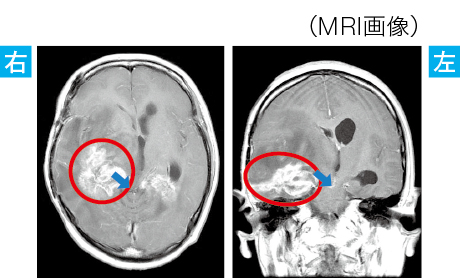 脳腫瘍による脳ヘルニアのMRI画像