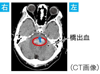脳出血による脳ヘルニアのCT画像