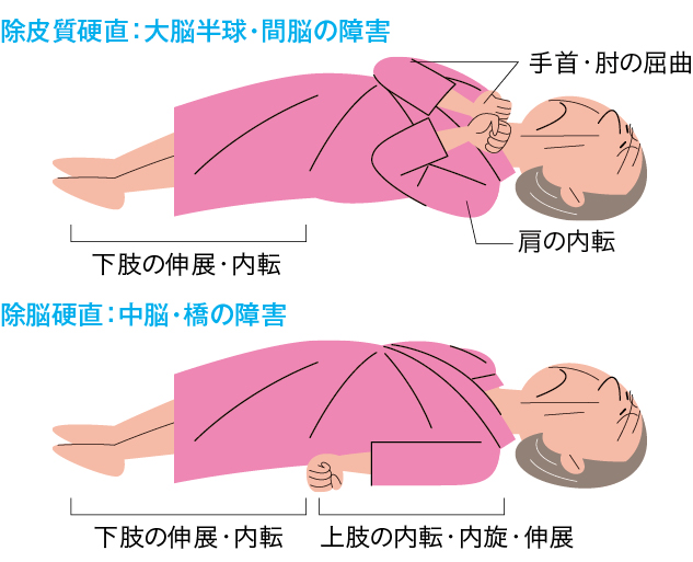 異常肢位（除皮質硬直・除脳硬直）のイラスト