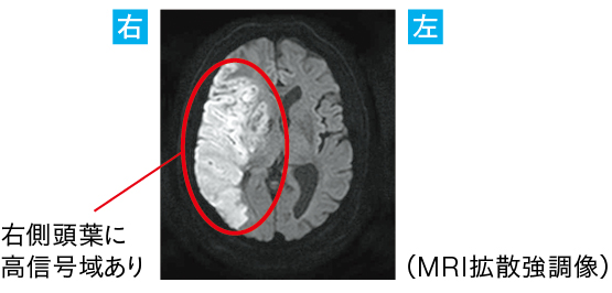 「中大脳動脈の閉塞」による“上行性網様体賦活系の障害”からくる意識混濁の画像