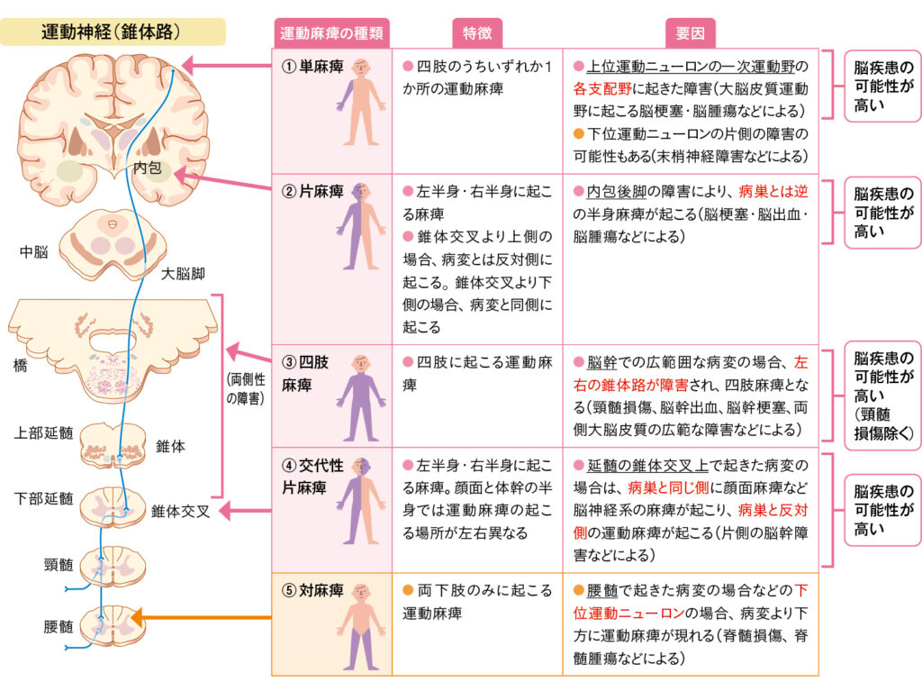 運動麻痺とは？症状・種類・評価方法・対応をわかりやすく解説 | エキスパートナースweb