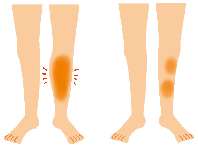 急性深部静脈血栓症の徴候①下肢の変化のイラスト