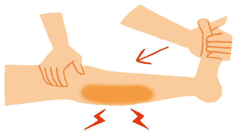 ホーマンズ徴候のイラスト