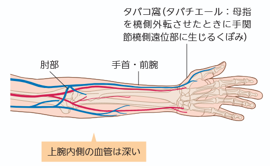 自己血管シャントの吻合によく使われる部位のイラスト