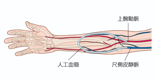 人工血管を留置した場合のイラスト