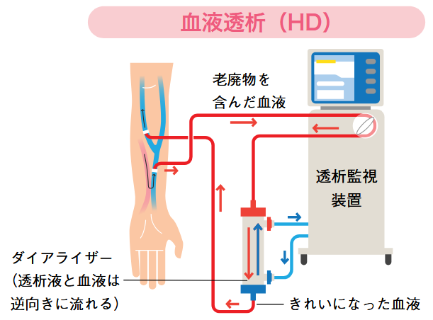 血液透析のイラスト