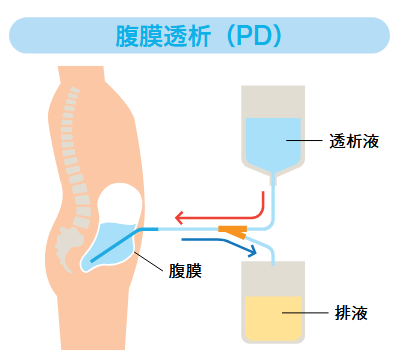 腹膜透析（PD）のイラスト