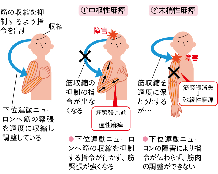 中枢性麻痺（痙性麻痺）と末梢性麻痺（弛緩性麻痺）のイラスト