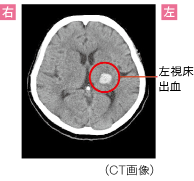 視床出血による“視床の障害”からくる感覚障害のCT画像