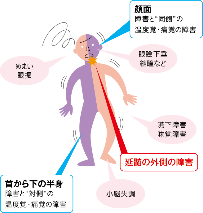 ワレンベルグ症候群の症状