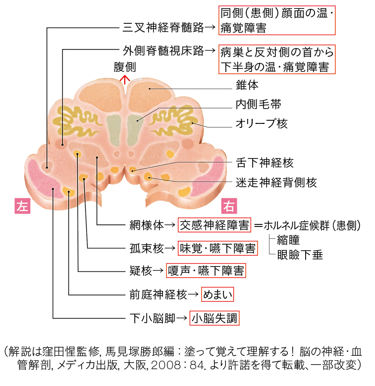 延髄の解剖と感覚障害の例のイラスト