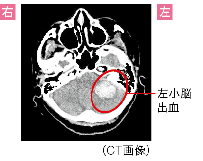 「小脳失調」による小脳失調症状のCT画像