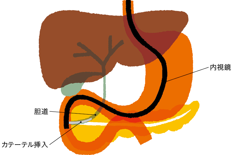 ERCPのイメージイラスト